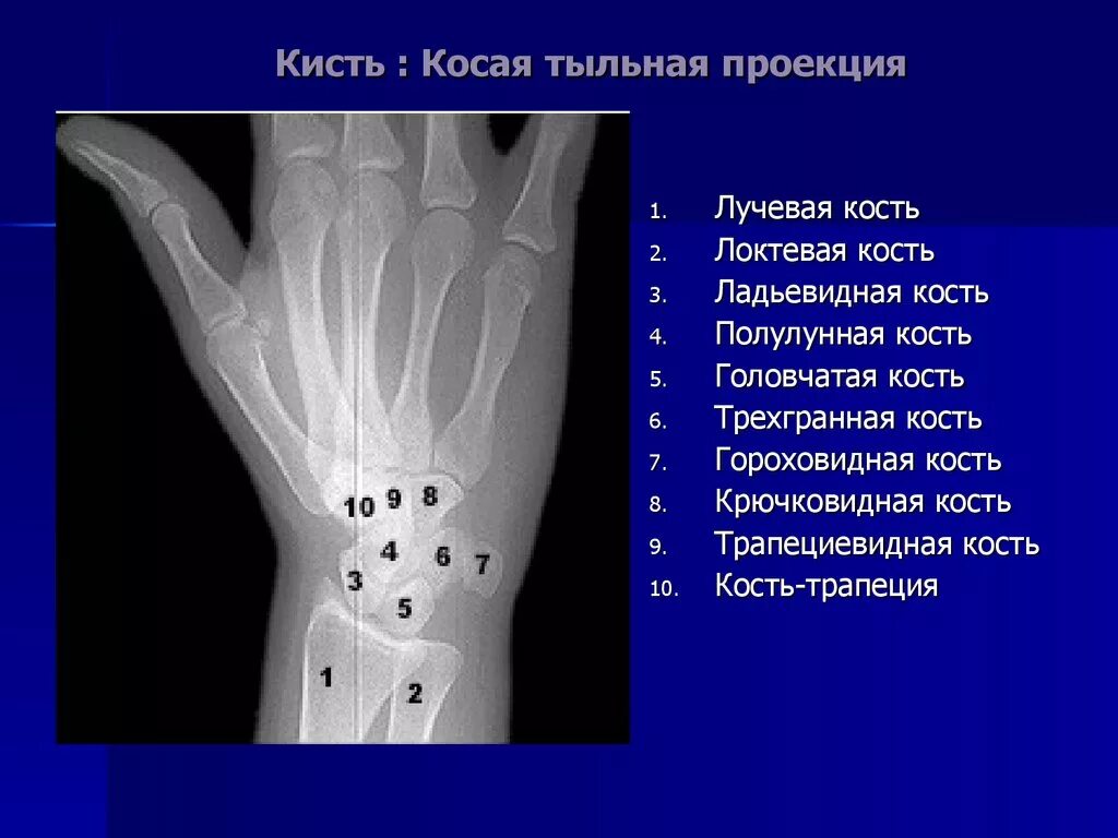 Картинки ГОЛОВЧАТАЯ КОСТЬ ЗАПЯСТЬЯ