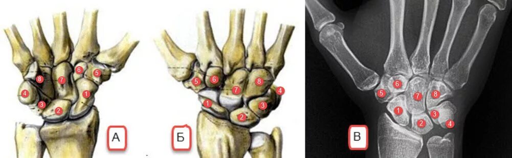 Полулунная кость запястья фото Отсутствие костей Doctor of Sciences