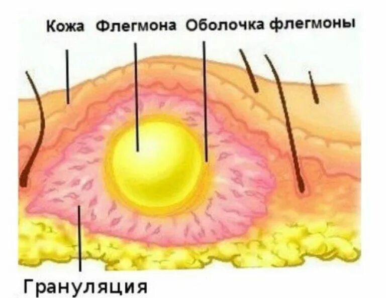 Ползучая флегмона при герпесе фото Флегмона мягких тканей