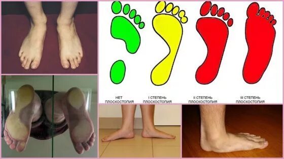 Поперечное плоскостопие симптомы фото Types of flat feet in adults and children