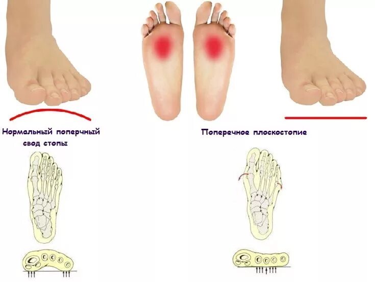 Поперечное плоскостопие симптомы фото Поперечное плоскостопие Плоскостопие, Гимнастические тренировки, Подошвенный фас
