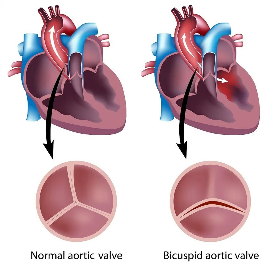 Порок сердца фото Actor Arnold Schwarzenegger reveals recent pacemaker surgery due to genetic hear