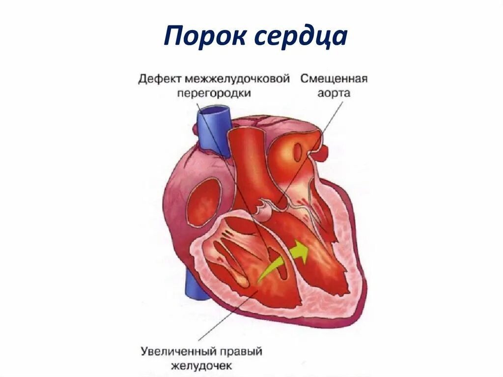 Порок сердца фото Первый порок сердца