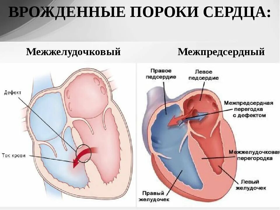 Порок сердца фото Дефект, стеноз, недостаточность. Обнаружили порок сердца, и что с этим делать? И