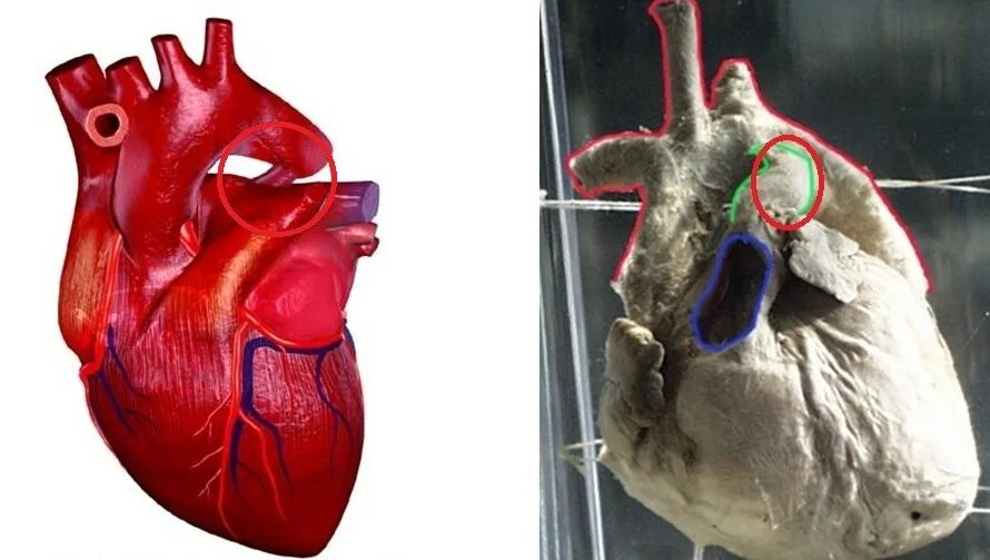 Порок сердца фото Patent ductus arteriosus pathophysiology - wikidoc