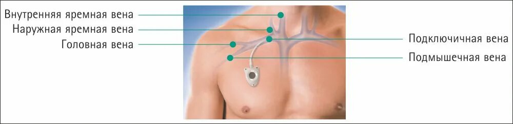 Порт система для химиотерапии фото Венозный порт для химиотерапии: установка порт-систем в Санкт-Петербурге