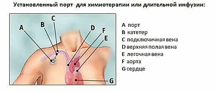 Порт система для химиотерапии фото Порт для химиотерапии что это такое