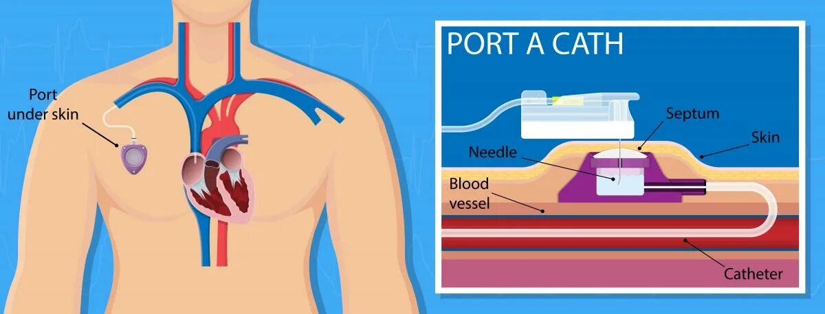 Порт система для химиотерапии установка фото Порт-системы для химиотерапии: установка, виды порт-катетеров, преимущества и не