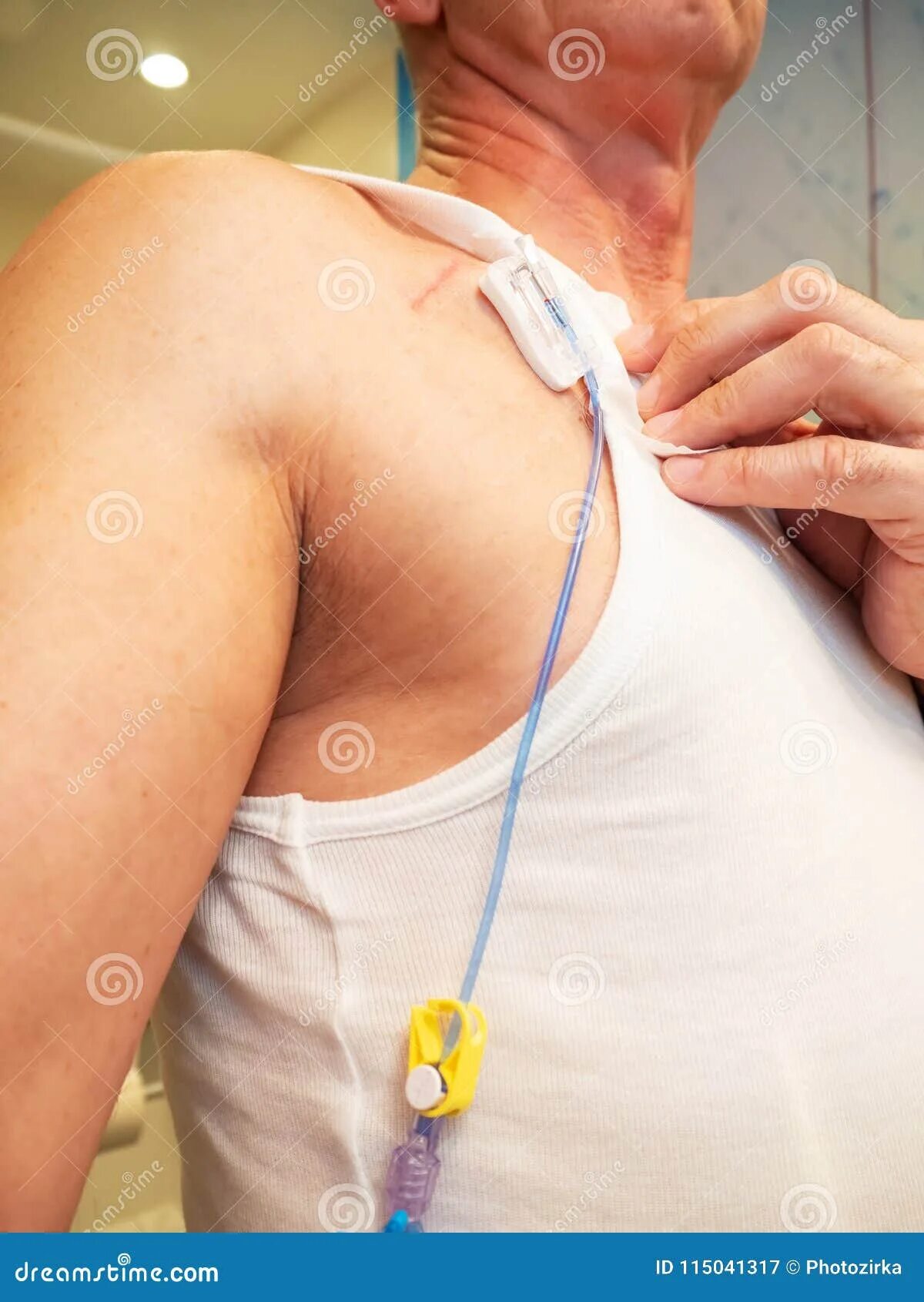 Порт система для химиотерапии установка фото Tube for Intravenous Fluids Injections To Implantable Port for C Stock Image - I