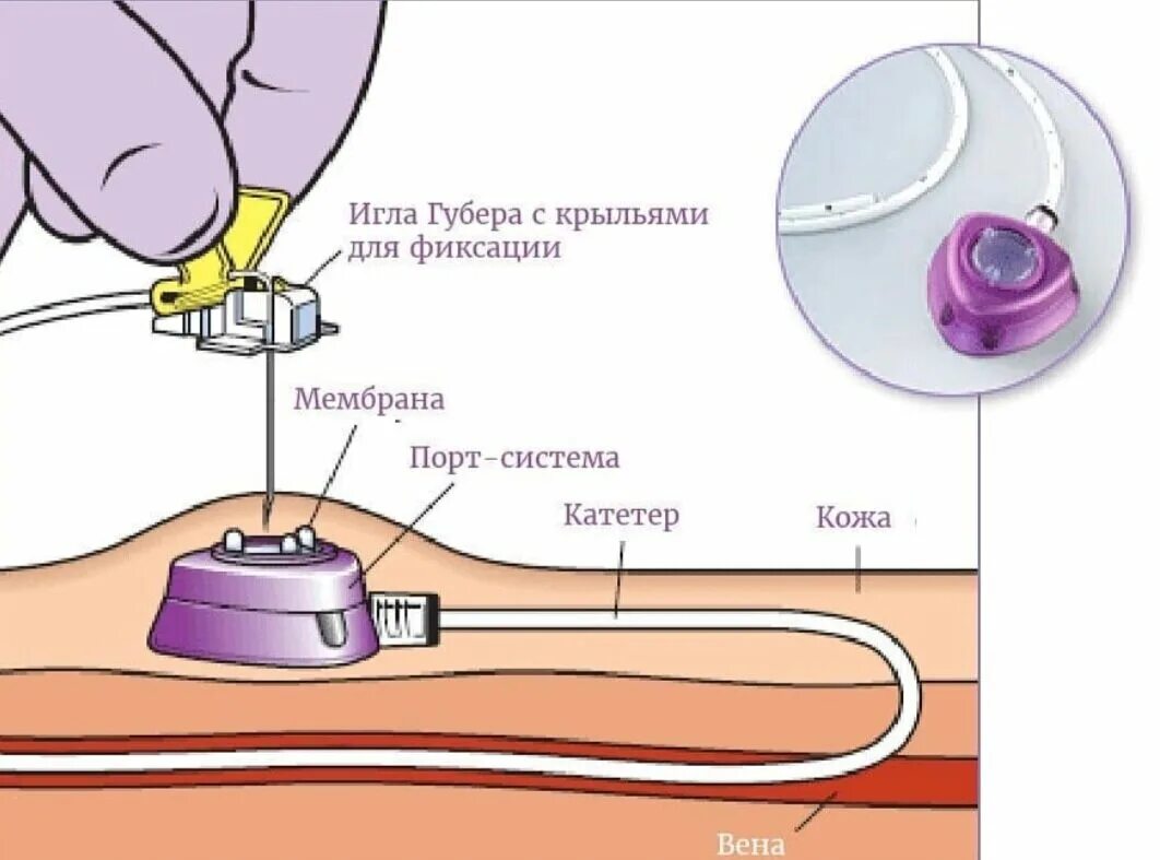 Порт система фото Как облегчить процесс химиотерапии? Онколог Базылев Дзен