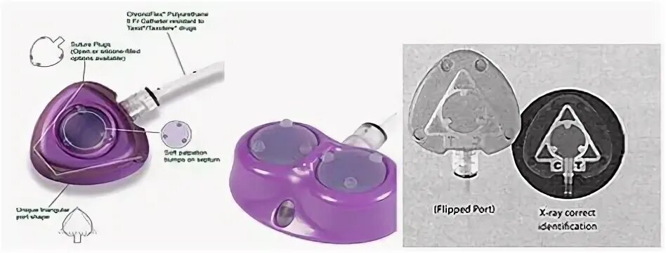 Порт система фото Vascular Access And Use Of Central Lines And Ports In