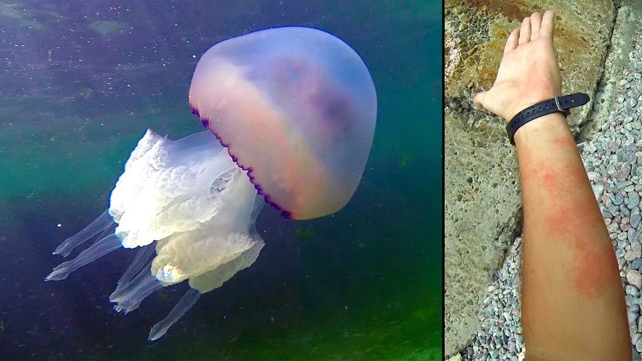 Португальский кораблик укус фото Что будет, если ужалит фиолетовый корнерот - YouTube