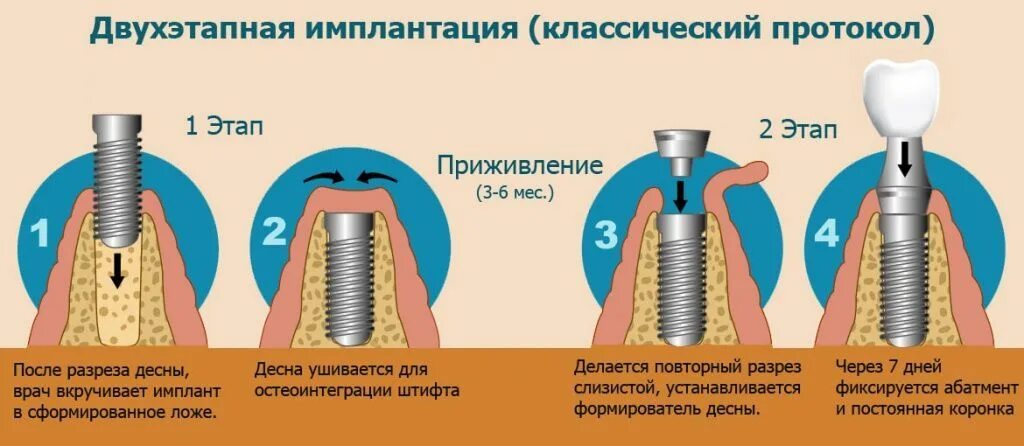 Порядок установки имплантантов зубов пошагово с фото Имплантация зубов в Москве - цена от 20 990 руб (имплант + установка) в "Центре 