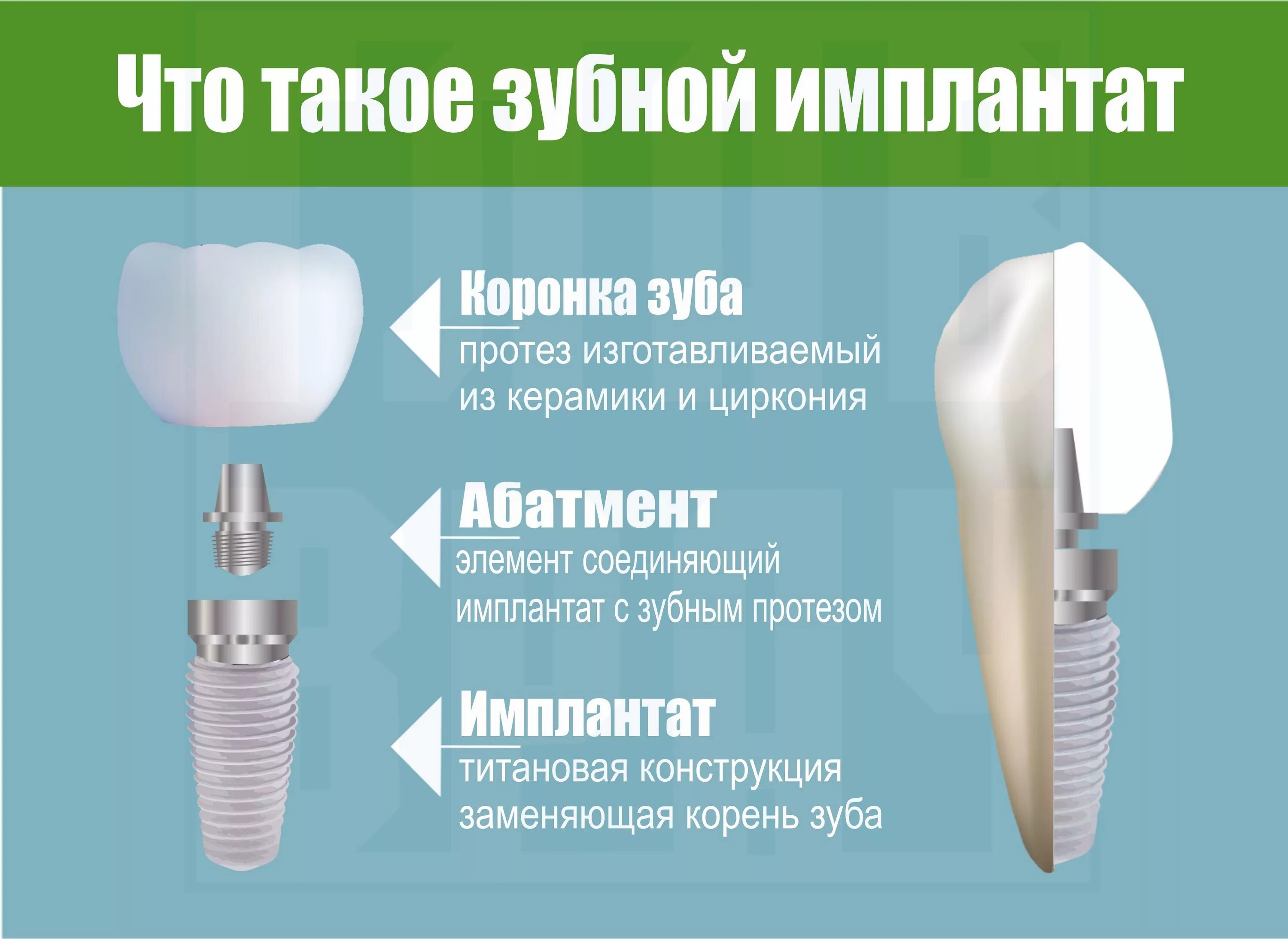 Порядок установки имплантантов зубов пошагово с фото Имплантация Зубов: Современное Решение для Восстановления Улыбки