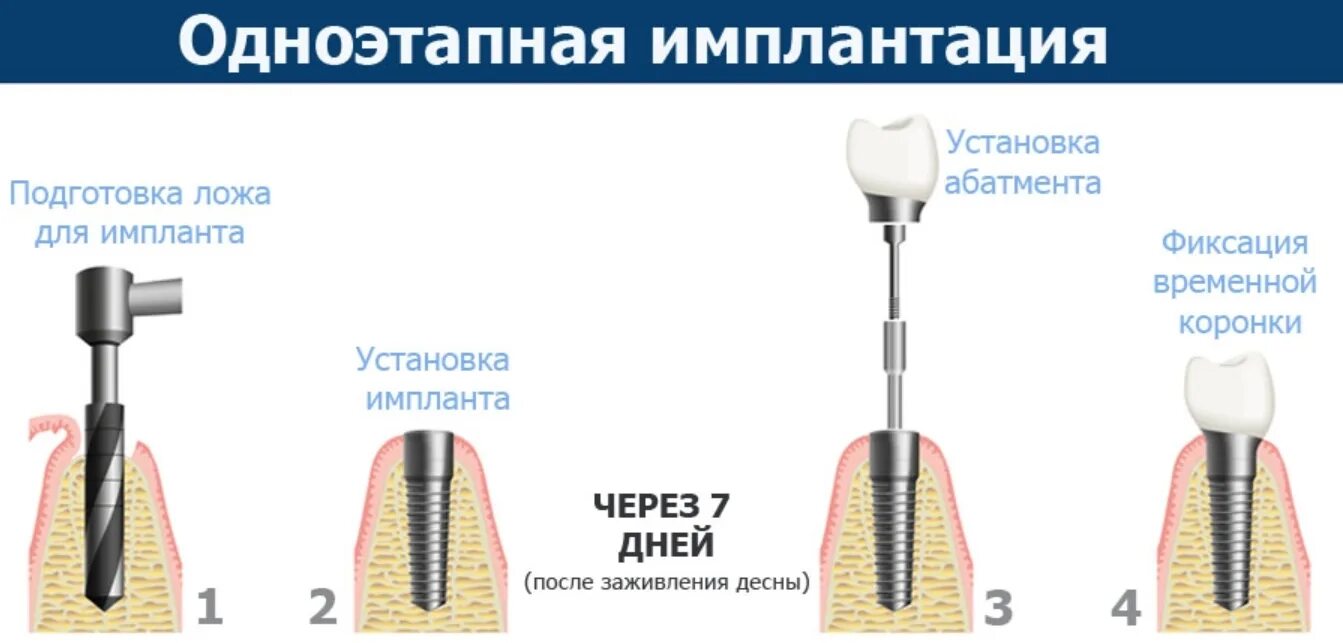 Порядок установки имплантантов зубов пошагово с фото Протокол дентальной имплантации