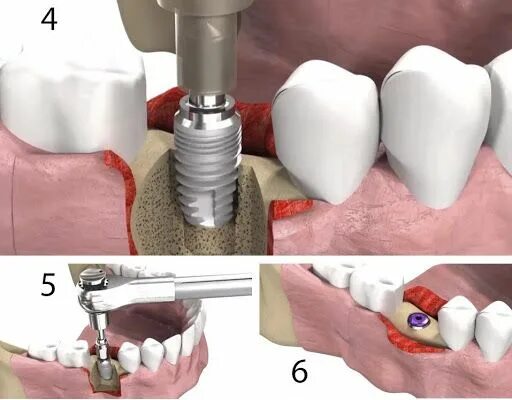 Порядок установки имплантантов зубов пошагово с фото Имплантация зубов: этапы, установка зубного импланта пошагово - клиника Доктора 