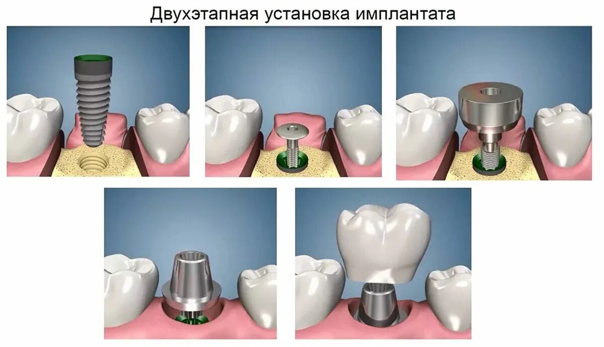 Порядок установки имплантантов зубов пошагово с фото Имплантация с отсроченной нагрузкой в Уфе, цена от 18000 руб.