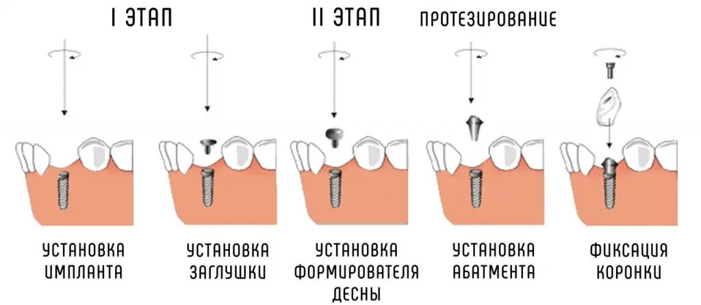 Порядок установки имплантантов зубов пошагово с фото Сравнение одноэтапной и двухэтапной методики имплантации зубов. Доступная стомат