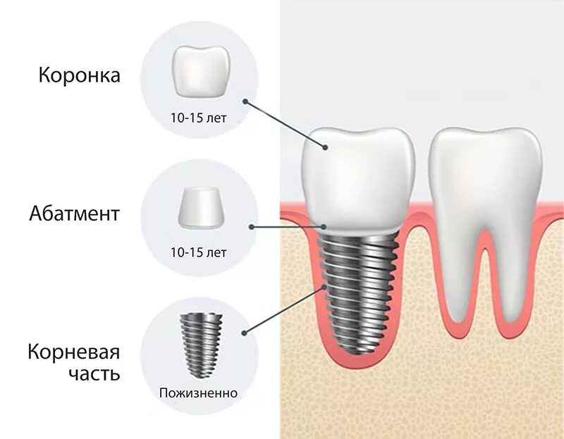 Порядок установки имплантантов зубов пошагово с фото Сроки гарантии на импланты зубов