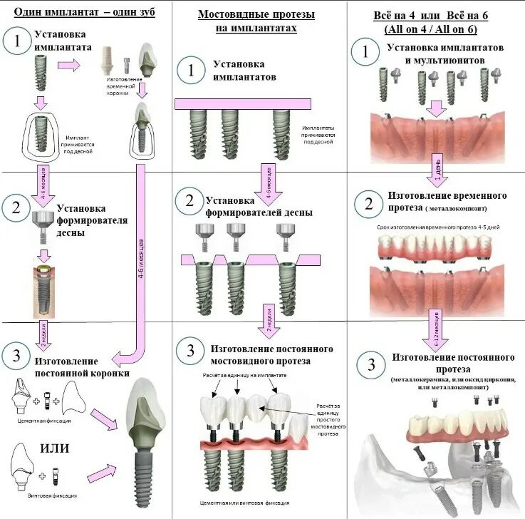 Порядок установки имплантов зубов пошагово с фото Виды имплантации в стоматологии Мирана Дент в Москве