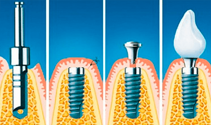 Порядок установки имплантов зубов пошагово с фото Имплантация зубов под ключ в Москве - цена Стоматология "Французский стандарт"