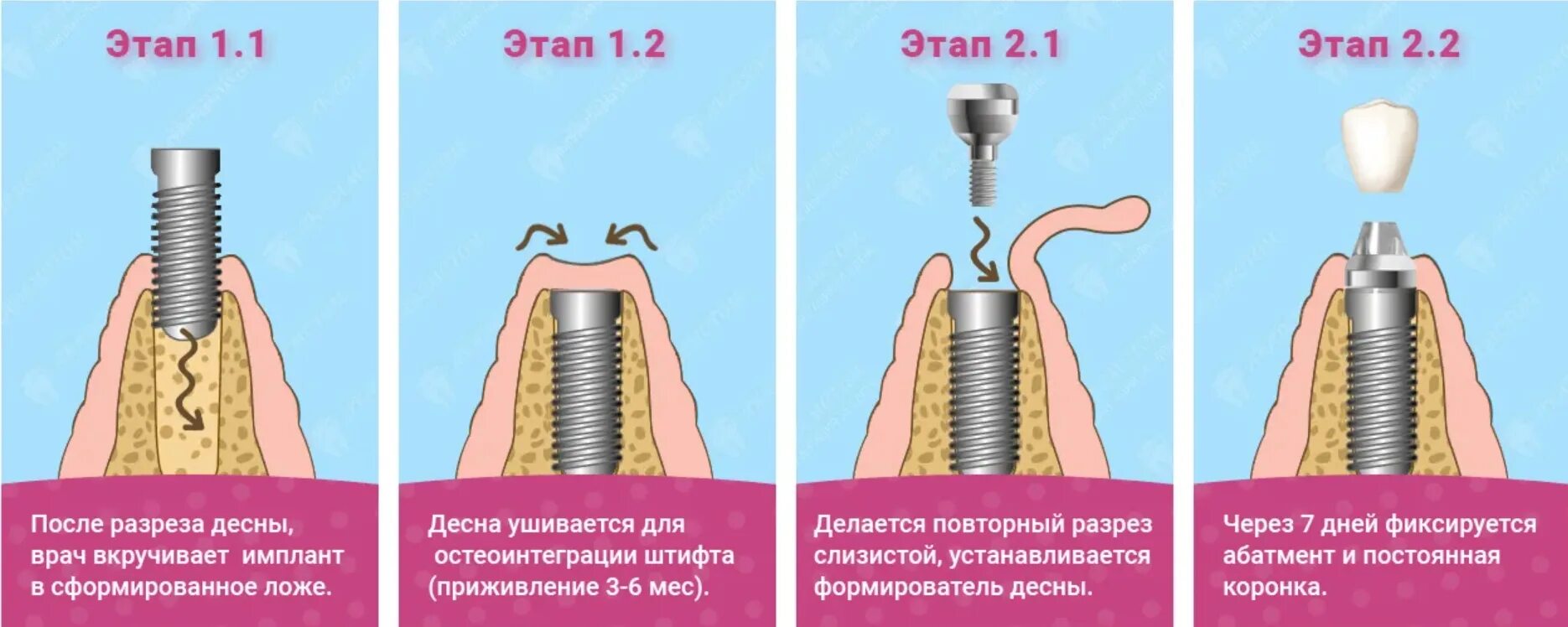 Порядок установки имплантов зубов пошагово с фото Имплантация зубов: основные этапы операции