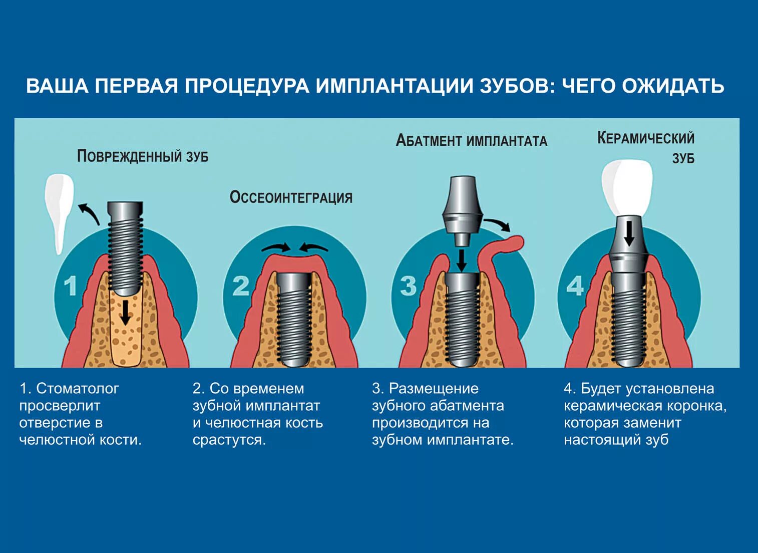 Порядок установки имплантов зубов пошагово с фото Имплантация описание