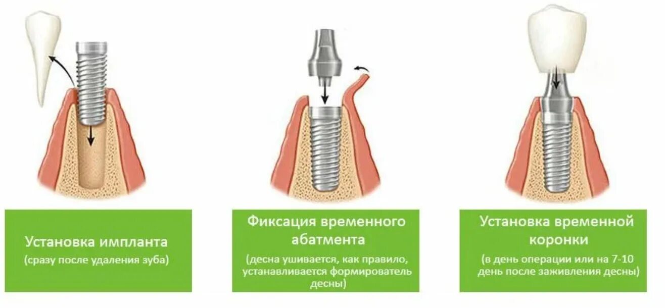 Порядок установки имплантов зубов пошагово с фото Имплантация после удаления зуба - Cтоматология Май