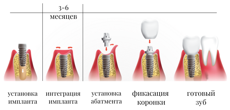 Порядок установки имплантов зубов пошагово с фото Имплантация зуба этапы и сроки