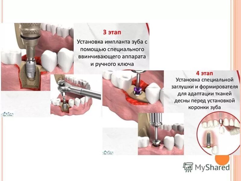 Порядок установки имплантов зубов пошагово с фото Схема установки импланта зуба