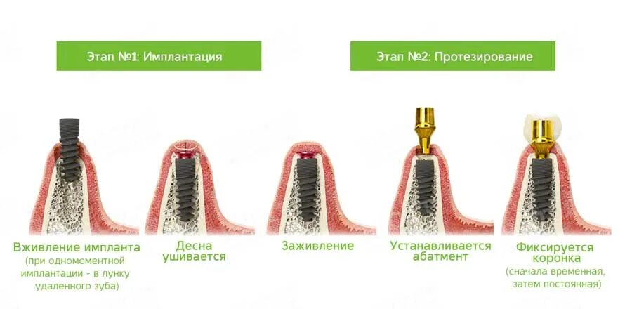 Порядок установки имплантов зубов пошагово с фото Имплантация зубов - Стоматологическая клиника "Имплант Люкс"