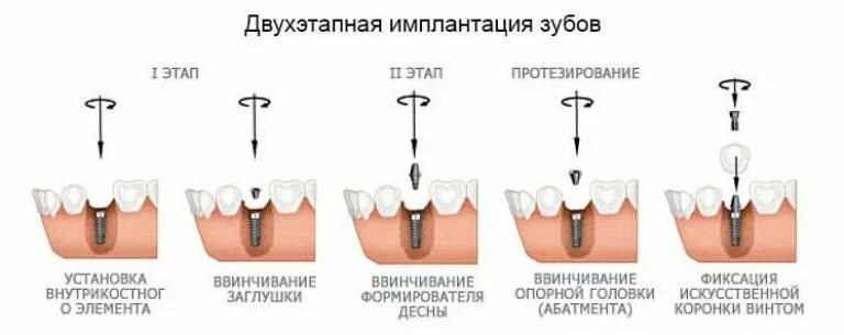 Порядок установки имплантов зубов пошагово с фото Двухэтапная имплантация зубов в Москве: цены в стоматологии "Техно-Дент"