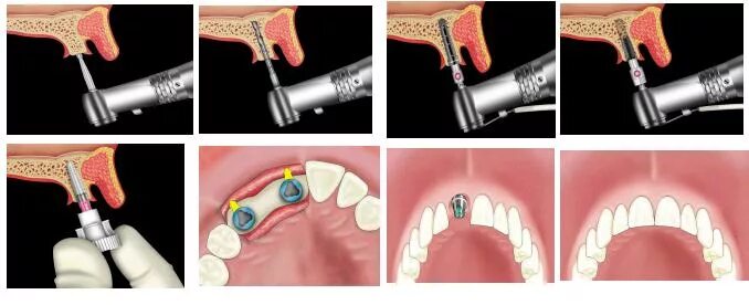 Порядок установки имплантов зубов пошагово с фото Имплантация зубов в Барнауле