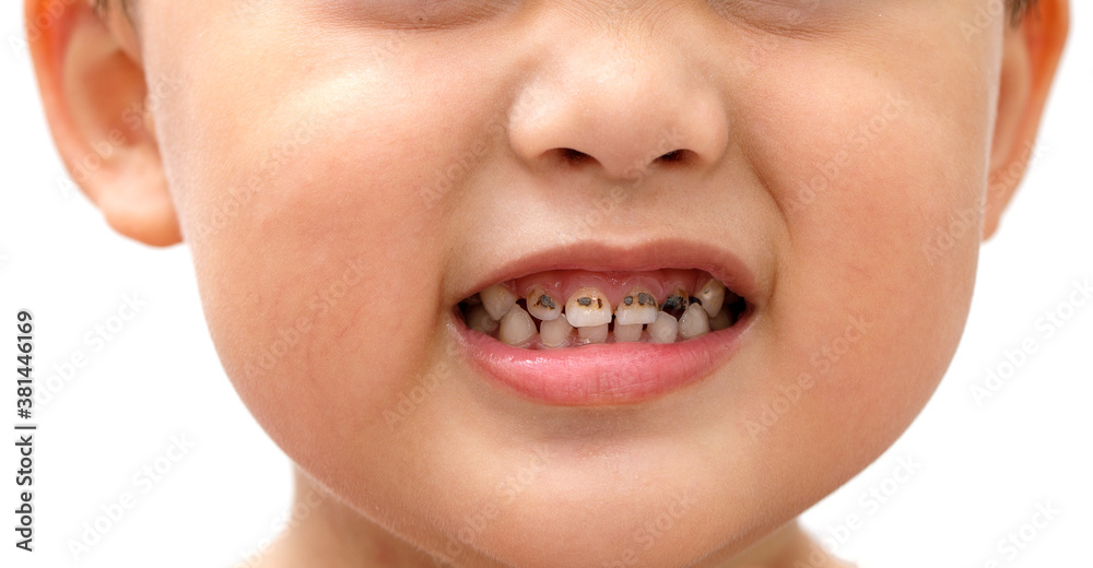 Посеребренные зубы у детей как выглядят Tooth decay of children who like to eat sweets candy. And doesn't like brushing 