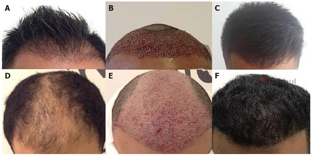 После 2 месяцев пересадки волос фото Can A Hair Transplant Increase Hair Density? Wimpole Clinic