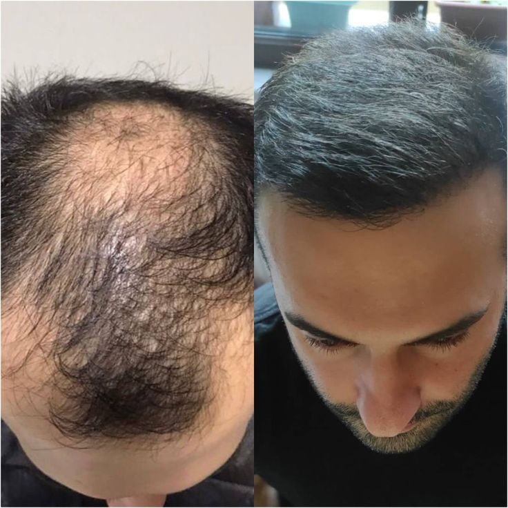 После 2 месяцев пересадки волос фото Hair Transplant Best hair transplant, Hair transplant, Cool hairstyles