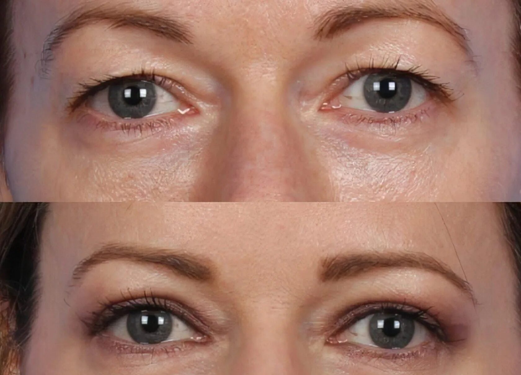 После ботокса опустились веки фото What is Hooded Eye Surgery? Your Definitive Guide to Blepharoplasty