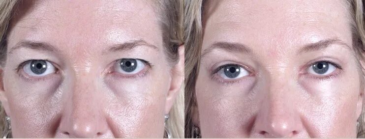 После ботокса опустились веки фото New Jersey Eyelid and Brow lift Surgery at the Parker Center Discovers a Minimal