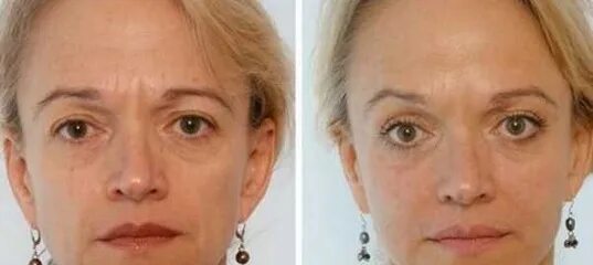 После ботокса опустились веки фото Nano-Botox will smooth out deep facial wrinkles in 14 days. Just now, a new, cra