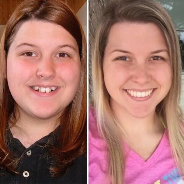 После брекетов изменилось лицо фото 114 Incredible Before & After Transformations Of People Who Wore Braces After br