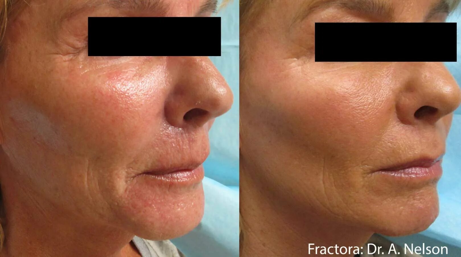 После игольчатого рф лифтинга реабилитация лица фото Skin Rejuvenation and Firming with Fractora RF Lexington, KY - Bemedispa