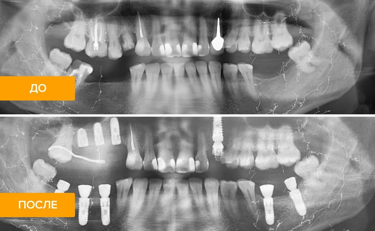 После имплантации зуба фото как выглядит Дентальная имплантация томск говорова