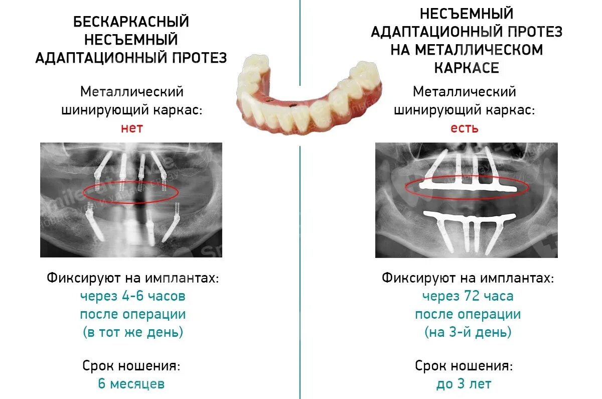 После имплантации зуба фото как выглядит Имплантация зубов за 1-3 дня: сколько служит протез - информация от стоматологов