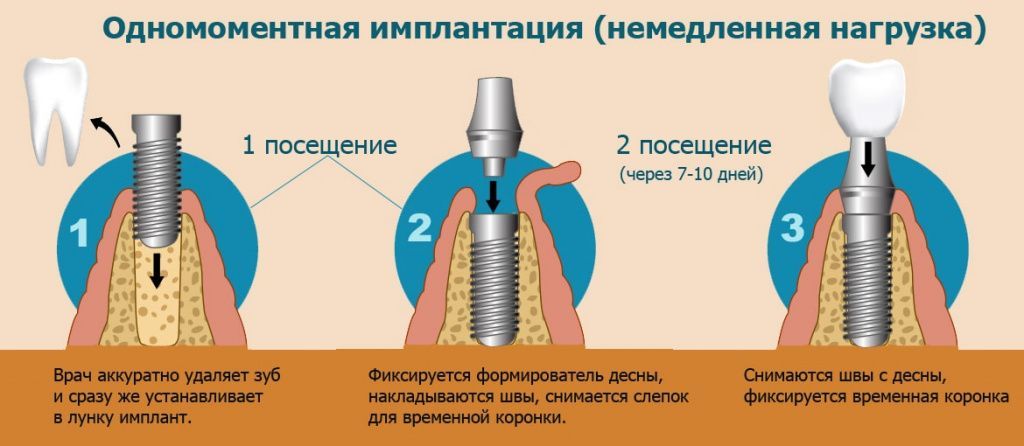 После имплантации зуба фото как выглядит Имплантация зубов в Москве - цена от 20 990 руб (имплант + установка) в "Центре 