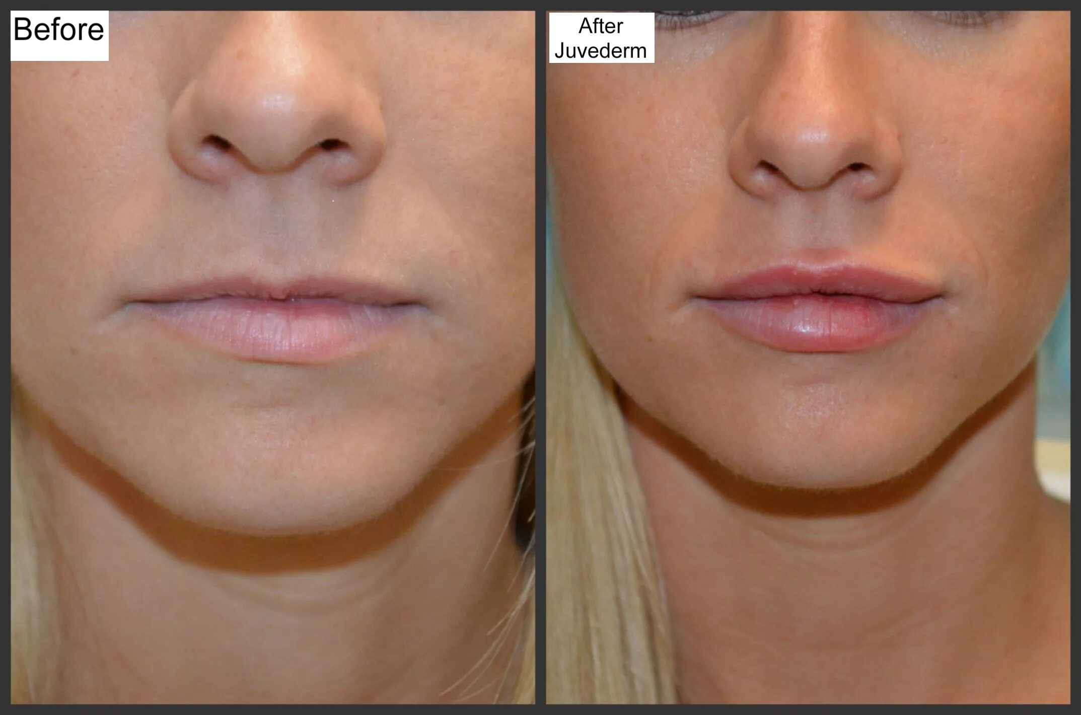 После контурной пластики губ фото отзывы Pin on Juvederm (New Lips)