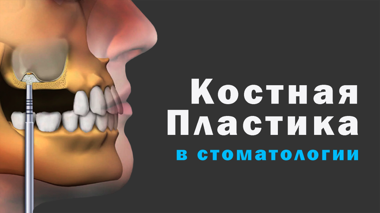 После костной пластики фото Виды костной пластика в стоматологии. После костной пластики - смотреть видео он