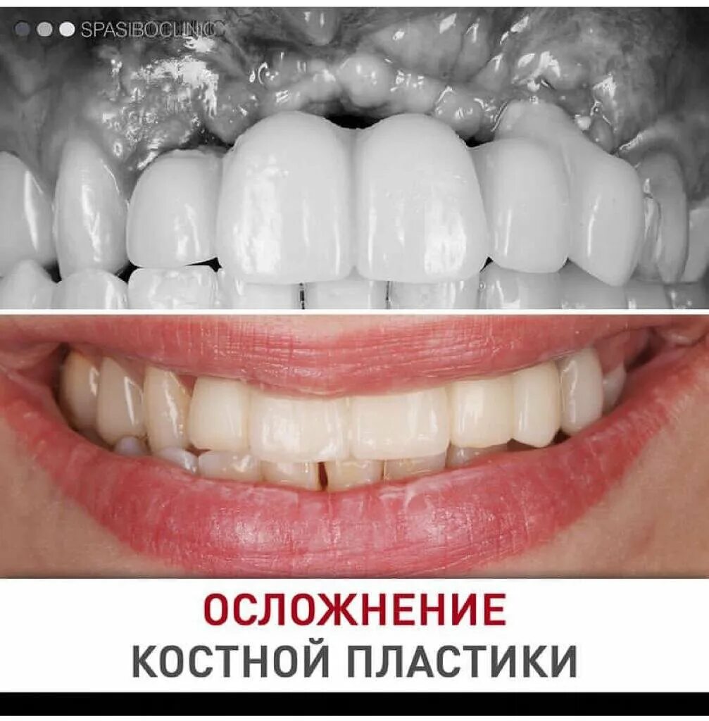 После костной пластики фото ОСЛОЖНЕНИЯ КОСТНОЙ ПЛАСТИКИ Спасибо.Клиник Дзен