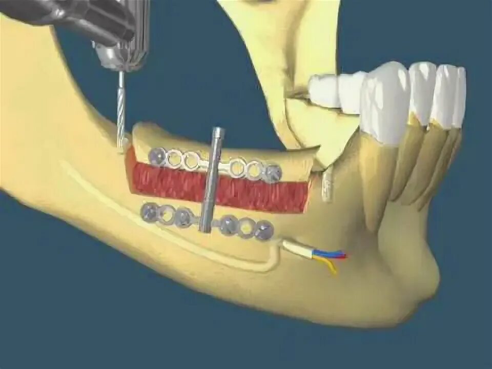 После костной пластики фото DISTRAÇÃO OSTEOGÊNICA POSTERIOR - YouTube