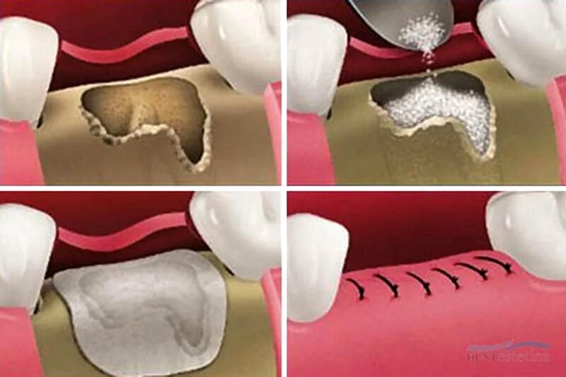 После костной пластики фото Bone Splitting & Spreading Definition, Ablauf, Kosten