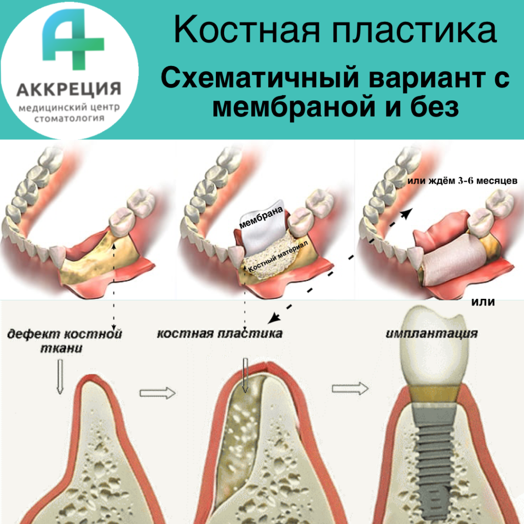 После костной пластики фото Костная пластика в Московском районе г. Санкт-Петербурга.